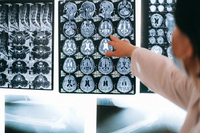 Understanding the Long-Term Impact of Traumatic Brain Injuries and the Role of an Injury Lawyer