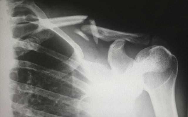 The Role of Rehabilitation After a Spinal Injury