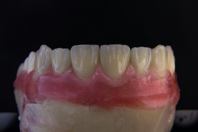 Smile with Confidence: How Dental Implants Can Boost Your Self-Esteem