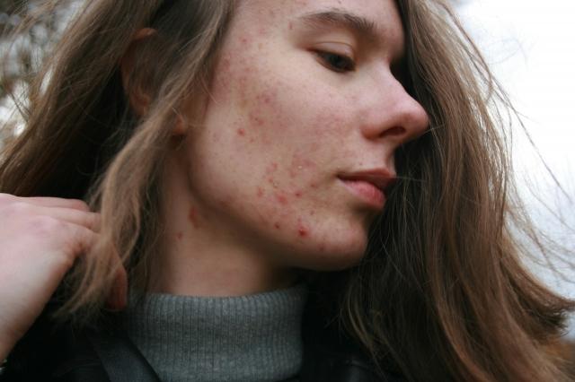 How Sleep Affects Skin Repair: Why Rest Matters for Acne Scar Recovery
