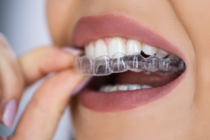 How Much Is Invisalign A Month in Belmont, MA?